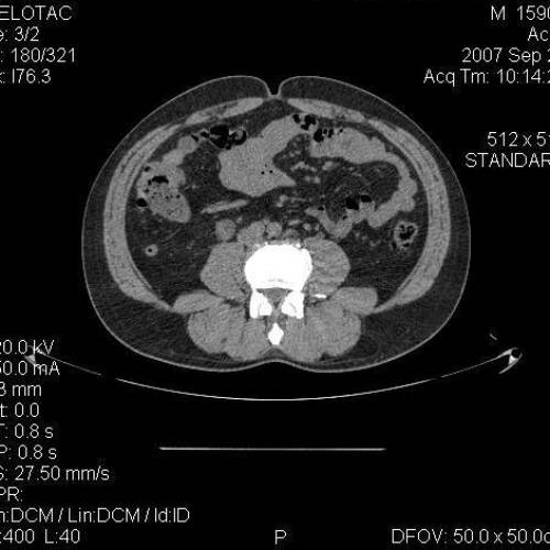 Apendicitis Retrocecal