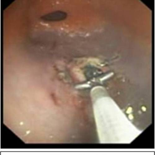 Mucosectomías Gástricas - Mucosectomía Adenocarcinoma In Situ