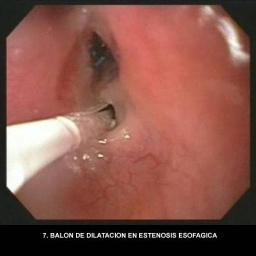 Estenosis Esofágica y Fístula Traqueoesofágica