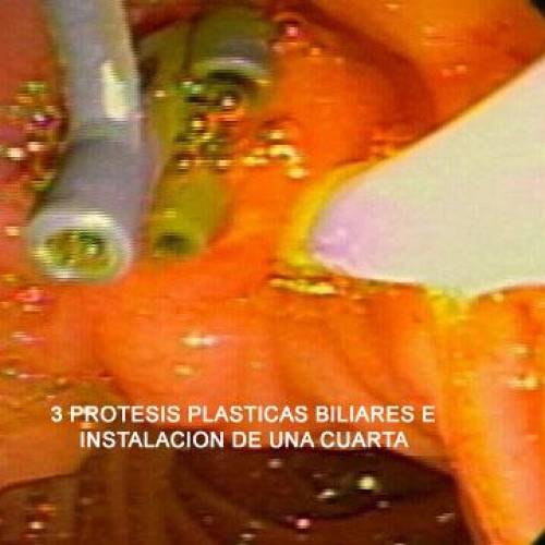 Estenosis Benigna de Via Biliar