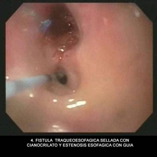 Estenosis Esofágica y Fístula Traqueoesofágica
