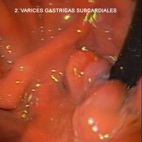 Várices Gástricas
