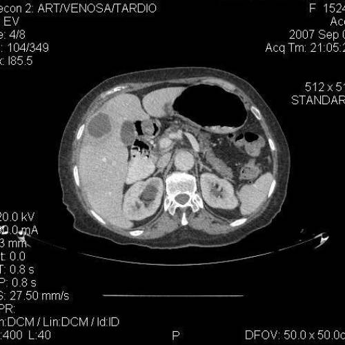 Abscesos Hepático 2