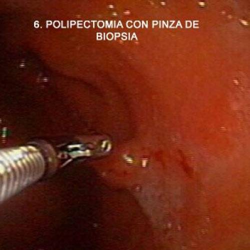 Pólipo Gástrico
