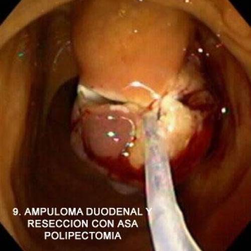 Ampuloma Duodenal