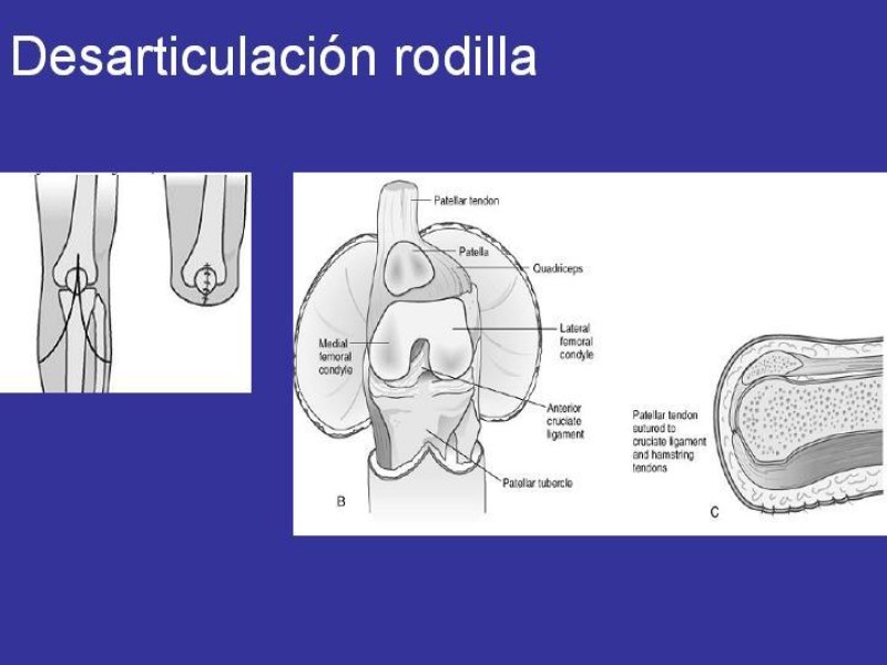 Diapositiva 11 de Desarticulación de rodilla y amputación supracondilea