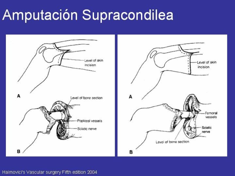 Diapositiva 12 de Desarticulación de rodilla y amputación supracondilea