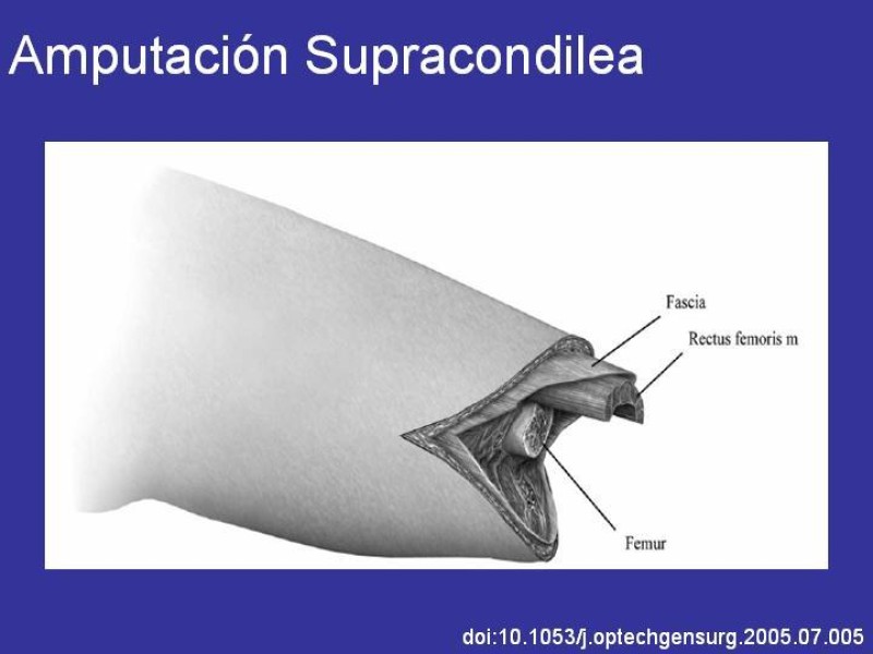 Diapositiva 13 de Desarticulación de rodilla y amputación supracondilea