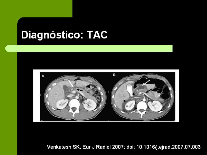 Diapositiva 17 de Trauma Pancreato-Duodenal