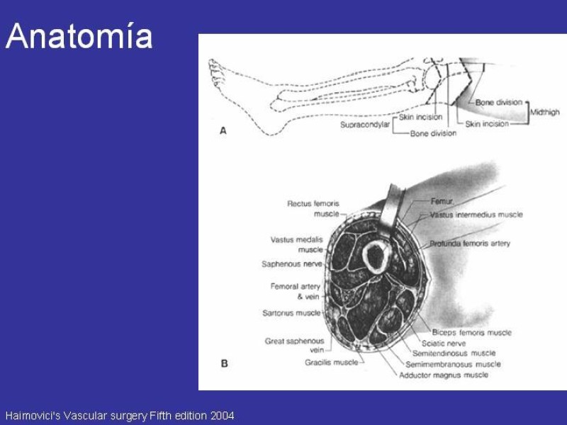 Diapositiva 5 de Desarticulación de rodilla y amputación supracondilea
