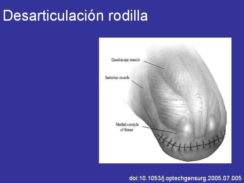 Diapositiva 9 de Desarticulación de rodilla y amputación supracondilea