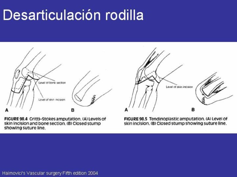 Diapositiva 10 de Desarticulación de rodilla y amputación supracondilea