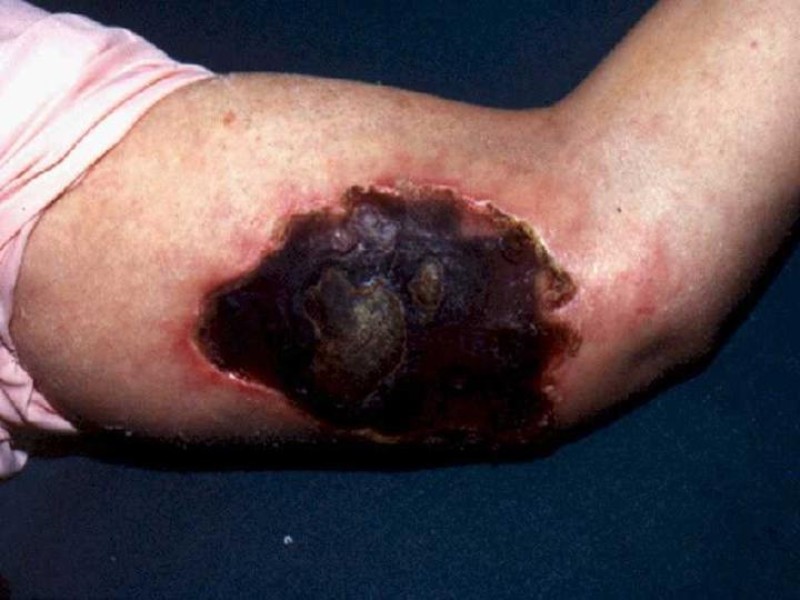 Diapositiva 25 de Celulitis, Erisipela y Loxoscelismo