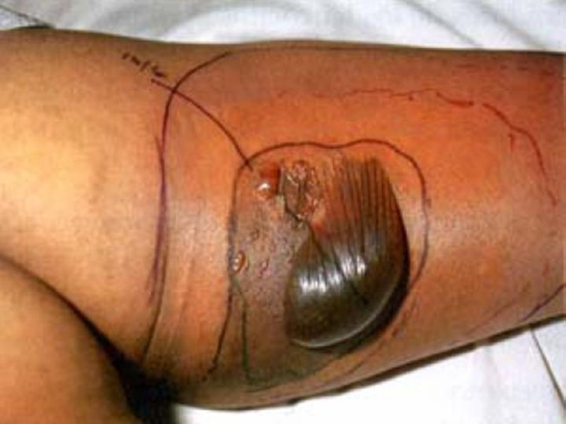 Diapositiva 21 de Celulitis, Erisipela y Loxoscelismo