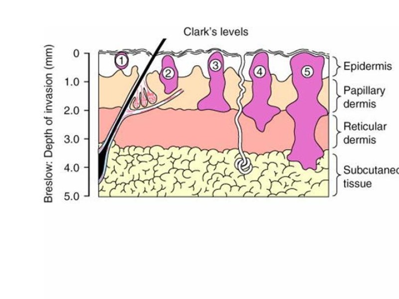 Diapositiva 6 de Manejo del Melanoma
