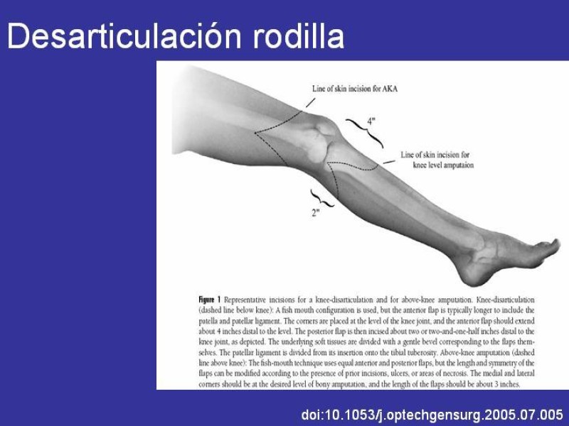 Diapositiva 7 de Desarticulación de rodilla y amputación supracondilea