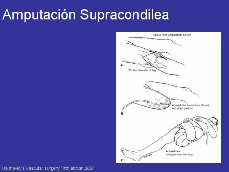 Diapositiva 14 de Desarticulación de rodilla y amputación supracondilea