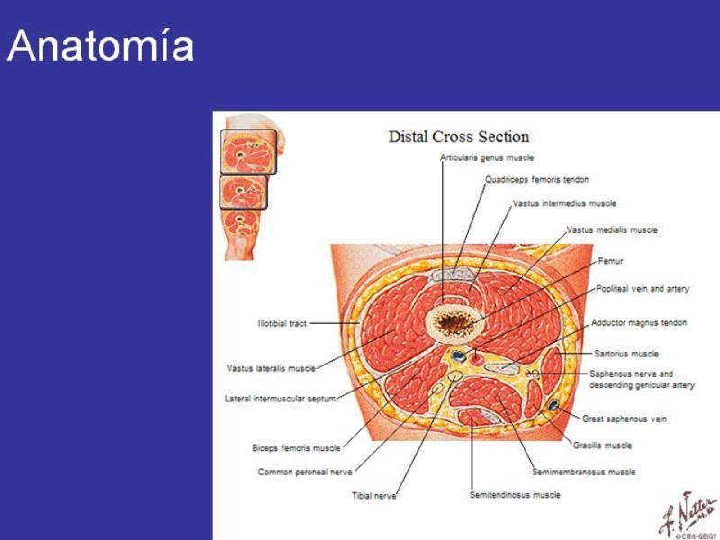 Diapositiva 4 de Desarticulación de rodilla y amputación supracondilea