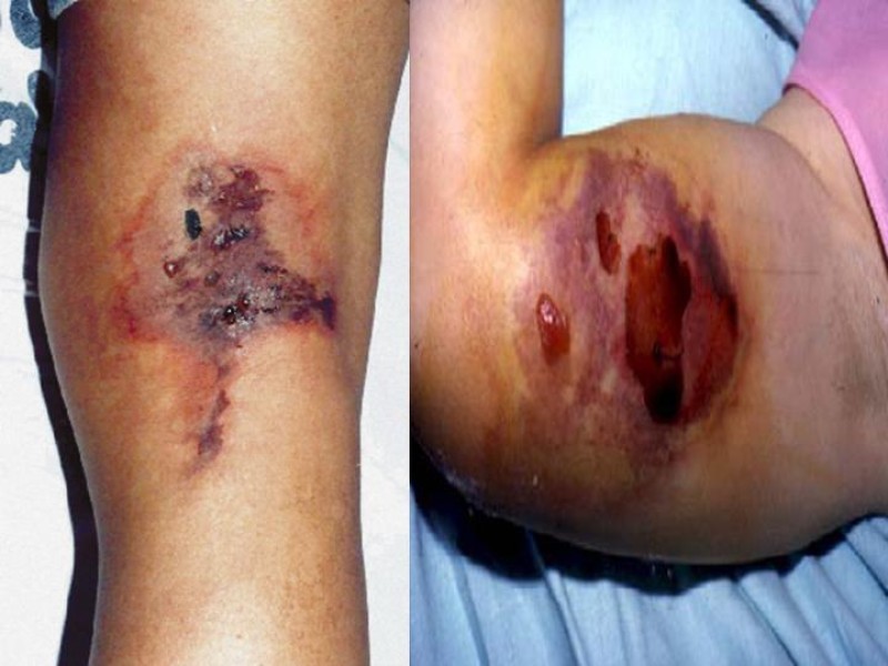 Diapositiva 23 de Celulitis, Erisipela y Loxoscelismo