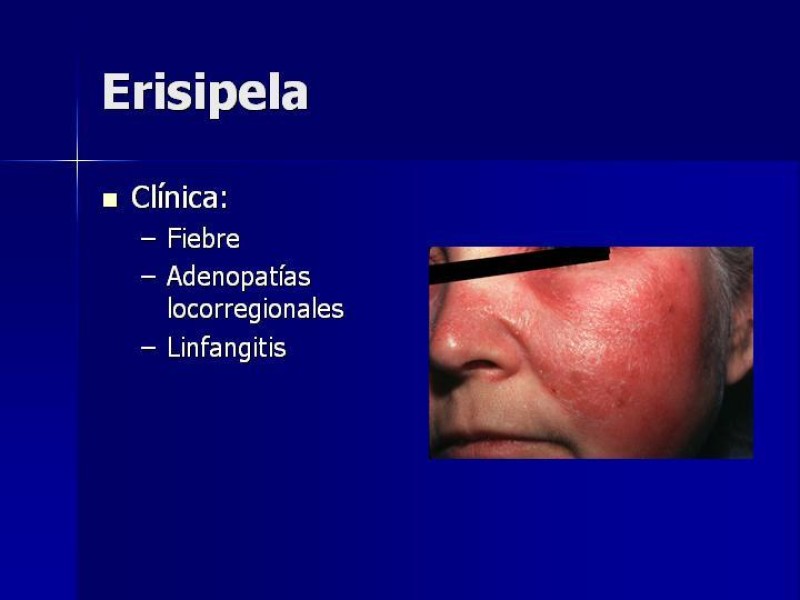 Diapositiva 4 de Celulitis, Erisipela y Loxoscelismo