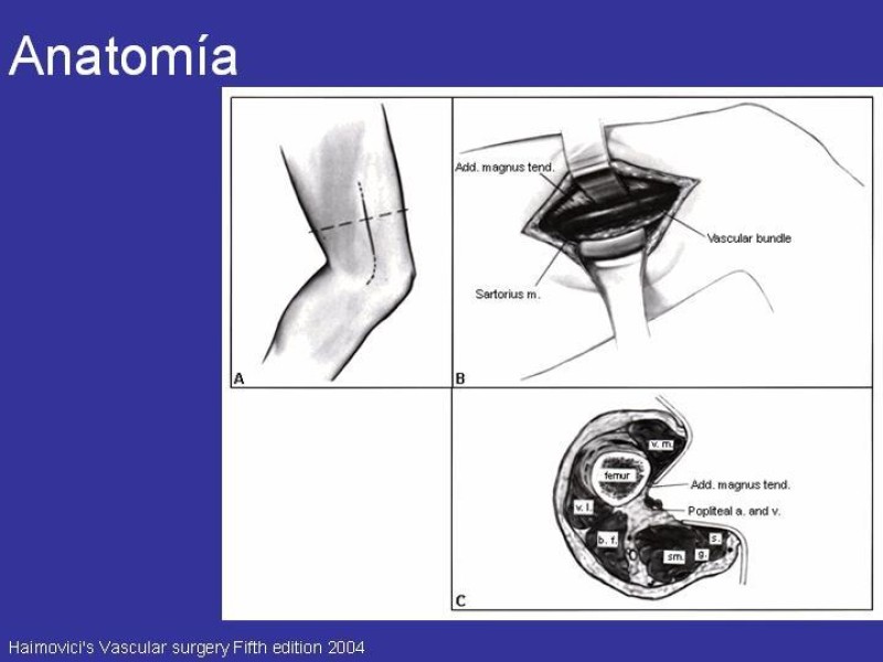 Diapositiva 6 de Desarticulación de rodilla y amputación supracondilea