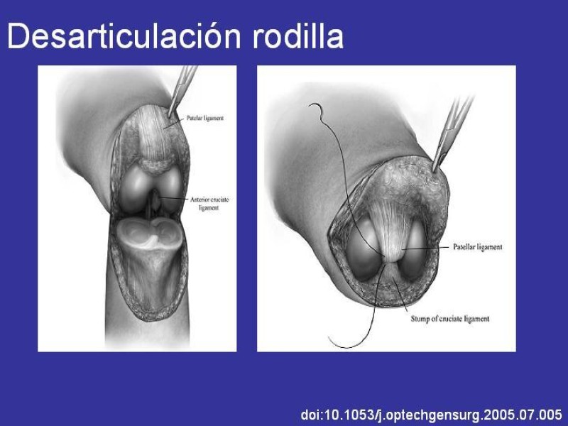 Diapositiva 8 de Desarticulación de rodilla y amputación supracondilea