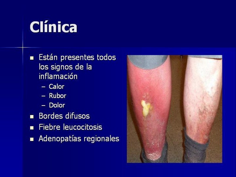 Diapositiva 9 de Celulitis, Erisipela y Loxoscelismo