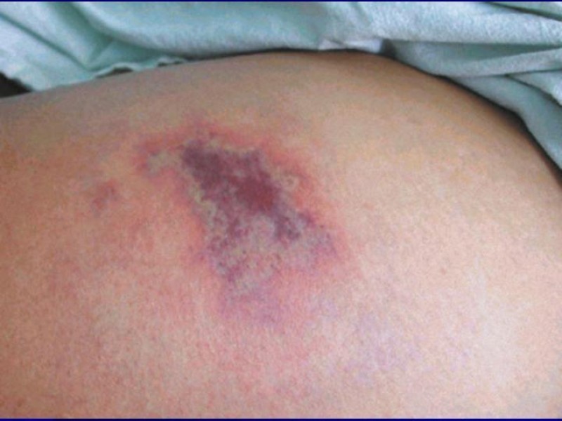 Diapositiva 20 de Celulitis, Erisipela y Loxoscelismo