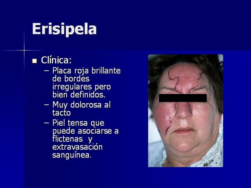 Diapositiva 3 de Celulitis, Erisipela y Loxoscelismo