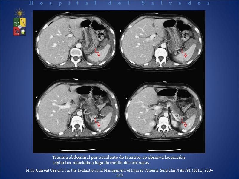 Diapositiva 8 de El rol del TAC de abdomen en Urgencia
