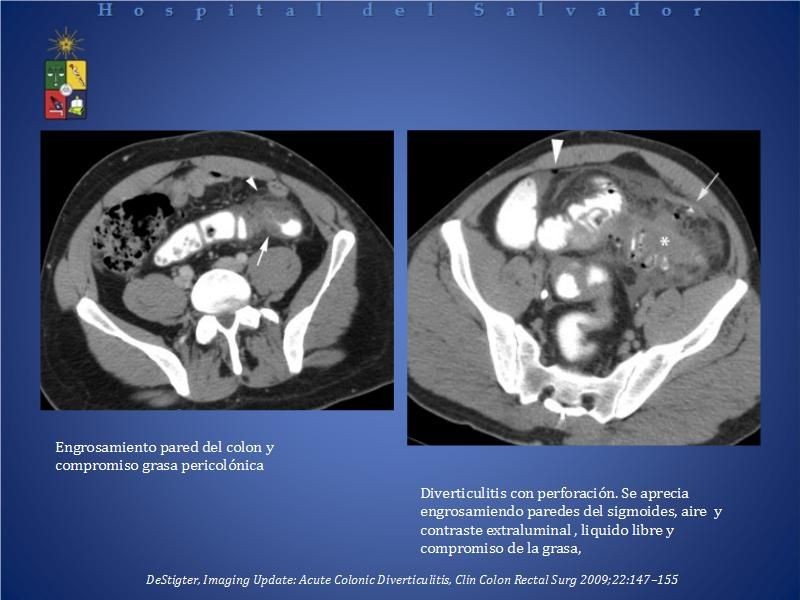 Diapositiva 20 de El rol del TAC de abdomen en Urgencia