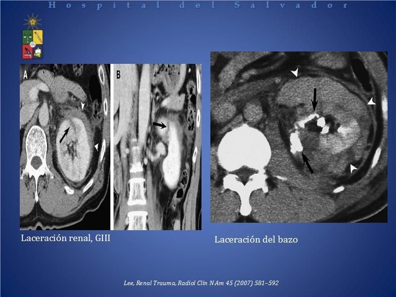 Diapositiva 12 de El rol del TAC de abdomen en Urgencia