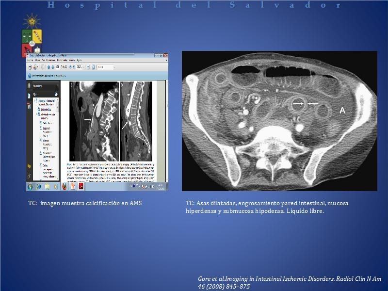 Diapositiva 26 de El rol del TAC de abdomen en Urgencia