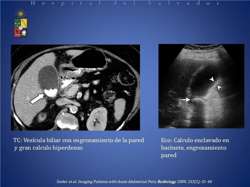 Diapositiva 16 de El rol del TAC de abdomen en Urgencia