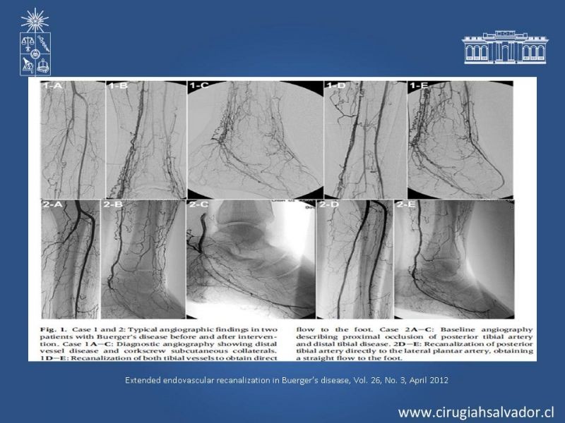 Diapositiva 15 de Enfermedad vascular no aterosclerótica: Diagnostico y manejo