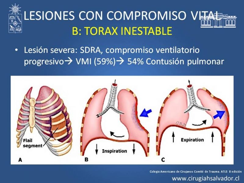 Diapositiva 31 de Trauma Torax I