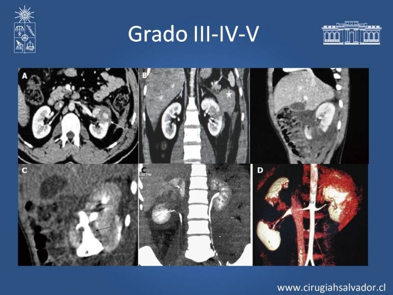 Diapositiva 9 de Trauma Renal