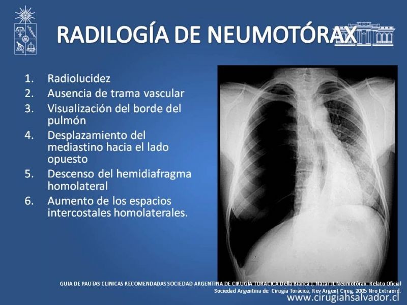 Diapositiva 19 de Trauma Torax I
