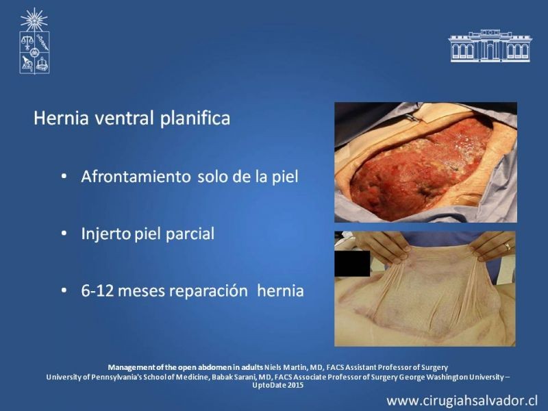 Diapositiva 14 de Laparostomía contenida