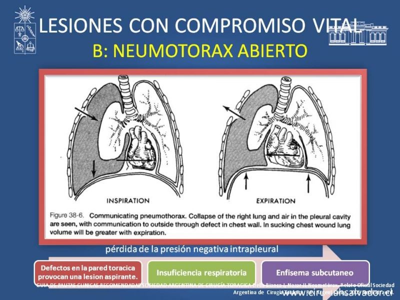 Diapositiva 23 de Trauma Torax I