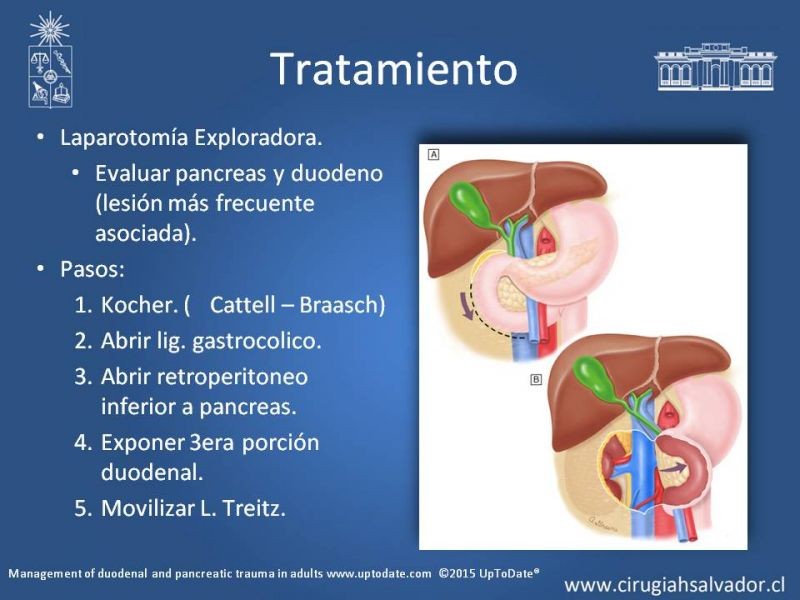 Diapositiva 16 de Trauma Pancreatoduodenal