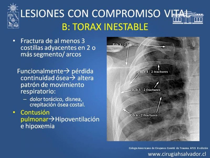 Diapositiva 30 de Trauma Torax I
