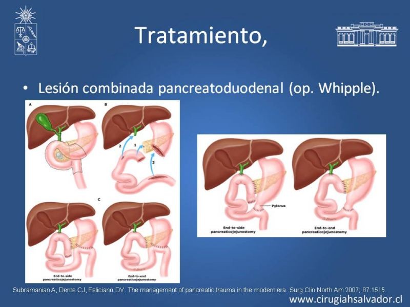 Diapositiva 30 de Trauma Pancreatoduodenal