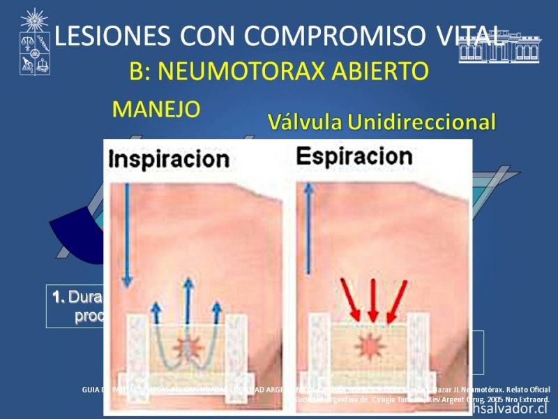 Diapositiva 25 de Trauma Torax I