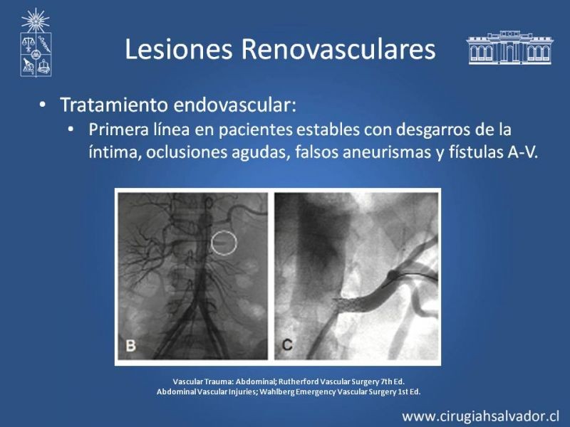 Diapositiva 42 de Trauma Vascular Abdominal