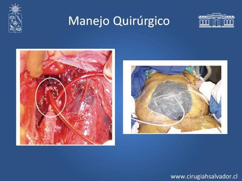 Diapositiva 22 de Trauma Vascular Abdominal