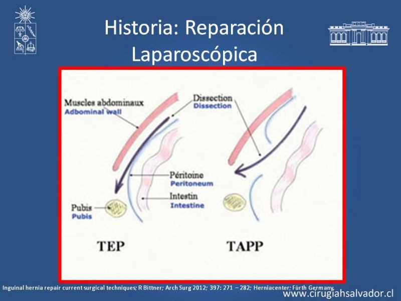 Diapositiva 5 de Hernioplastía Inguinal (Laparoscópica vs Abierta)