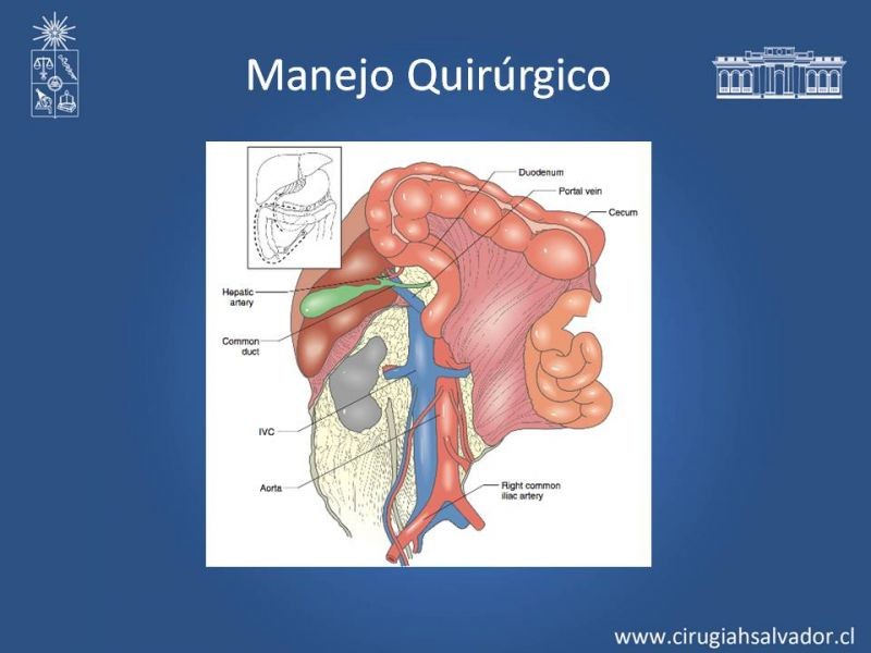 Diapositiva 18 de Trauma Vascular Abdominal