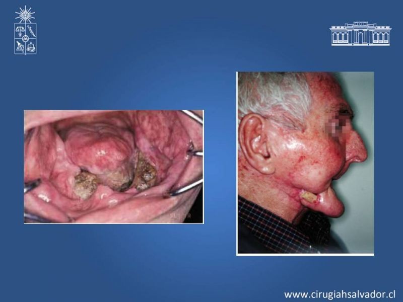 Diapositiva 11 de Osteoradionecrosis