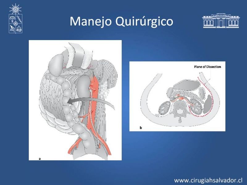 Diapositiva 18 de Lesión Vascular Abdominal